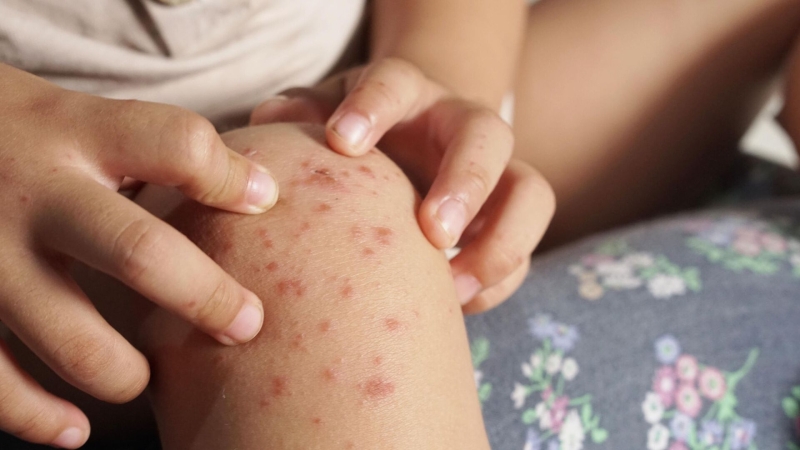 Вирус Коксаки: насколько опасен, лечение и меры профилактики